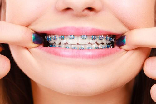 apparecchio per i denti raddrizzare i denti cesano maderno
