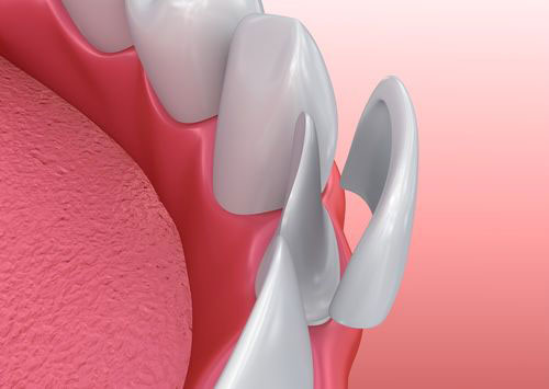 applicazione faccette dentali