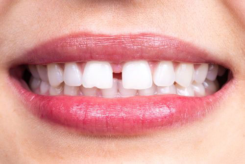 quando applicare le faccette dentali