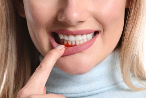 dentista cesano maderno cura dell'infiammazione gengivale, gengive infiammate