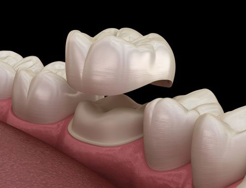 dentista cesano maderno protesi mobile e fissa